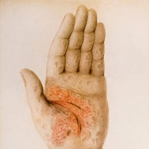 Psoriasis plaques on a hand