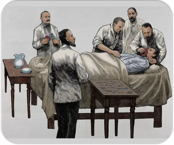History of medicine. Chloroform anesthesia. Engraving, 19th