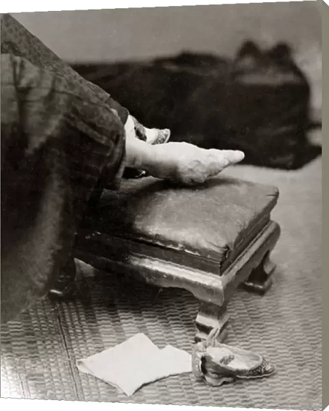 Bound foot, China, circa 1880s