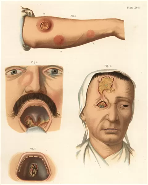 Tertiary period syphilis symptoms on the body