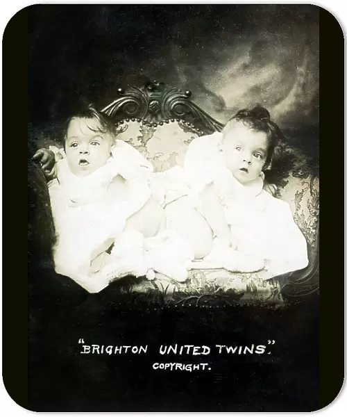 Famous conjoined sisters Daisy and Violet Hilton