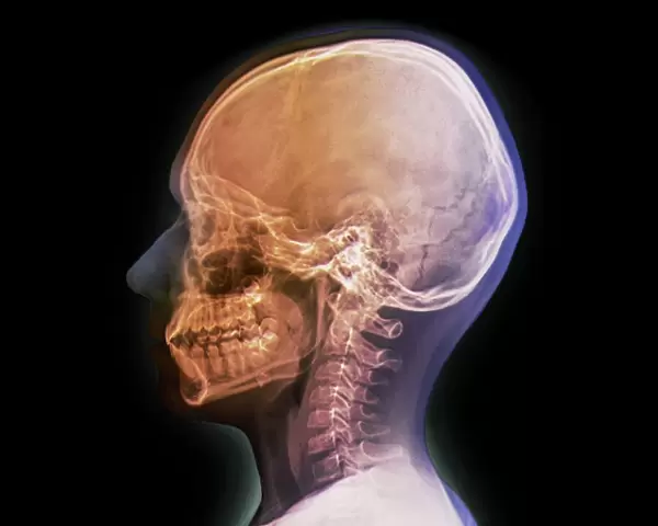 Normal childs head, X-ray