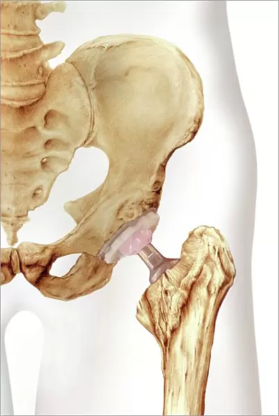 Hip replacement, artwork