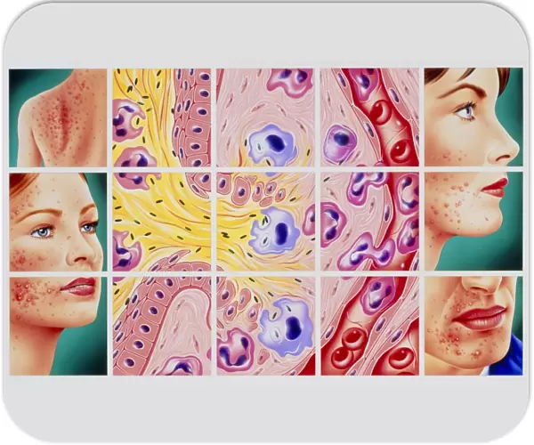 Artwork showing acne and rupture of follicle