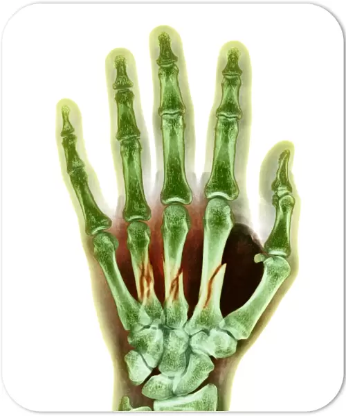Fractured palm bones of hand, X-ray