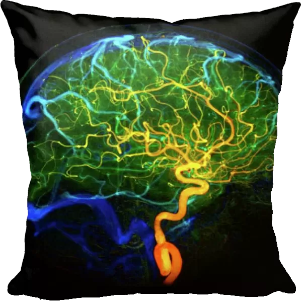 Brain blood vessels, 3D angiogram C007  /  1981