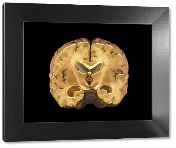 Healthy brain, MRI scan C018  /  0423