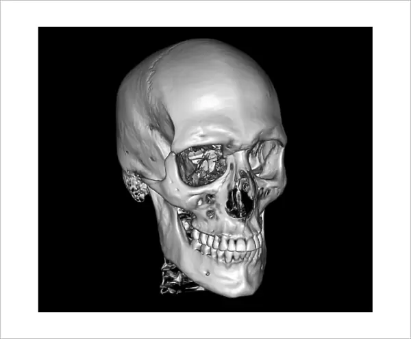Normal skull, 3D CT scan C016  /  6328