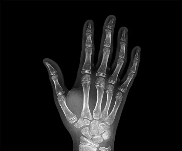 Broken wrist bone, X-ray C017  /  7187