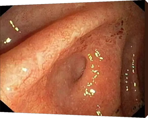Ulcerative pancolitis C018  /  0928