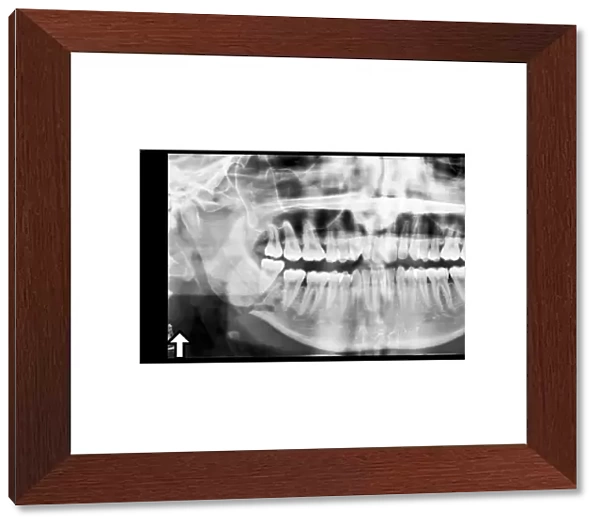 Broken jaw, X-ray C017  /  7557