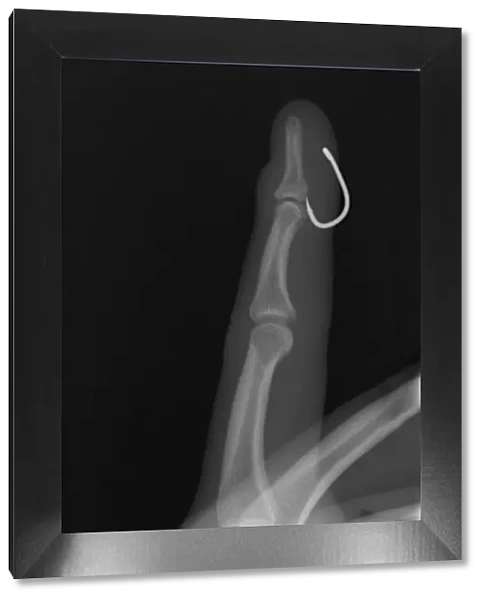 Fish hook in finger, X-ray C017  /  7160