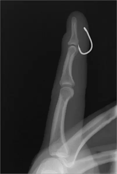 Fish hook in finger, X-ray C017  /  7160