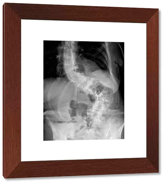 Scoliosis of the spine, X-ray C017  /  7167
