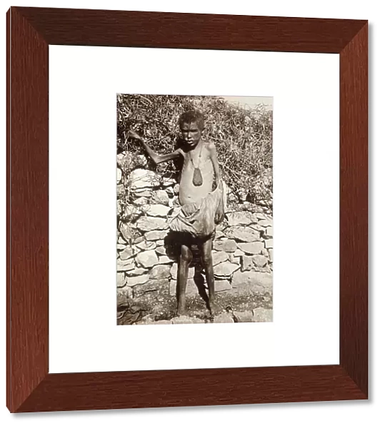 WWI: REFUGEES, 1919. A starving boy in northern Palestine, whose parents were both