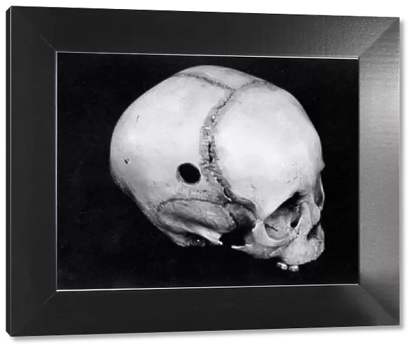 TREPANNING: SKULL. Trepanned Pre-Columbian skull found in Peru