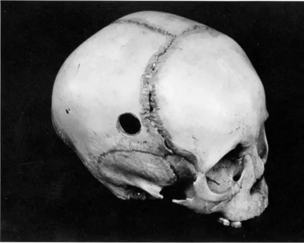TREPANNING: SKULL. Trepanned Pre-Columbian skull found in Peru