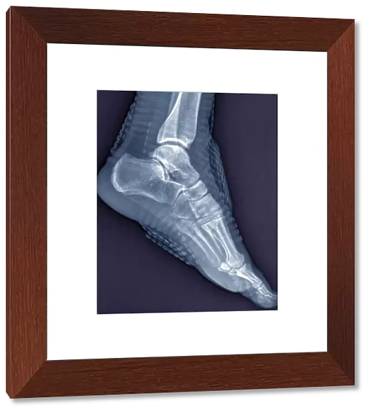 Healthy ankle joint, X-ray