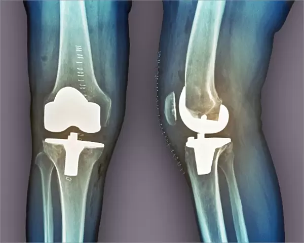 Total knee replacement, X-rays