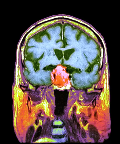 Pituitary tumour, CT scan