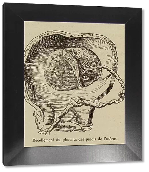Placental abruption (engraving)