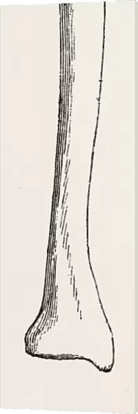 diagram representing a curved tibia, with a wedge removed, medical equipment, surgical