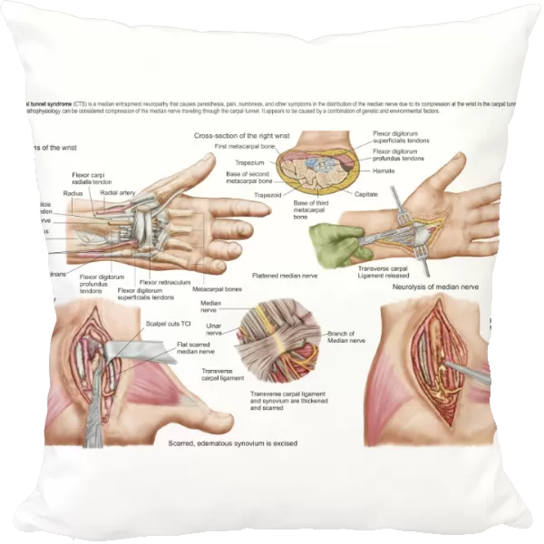 Medical illustration showing carpal tunnel syndrome in the human wrist