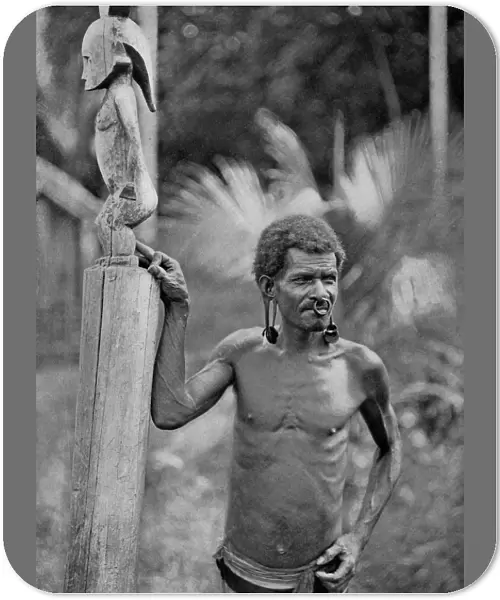 Malformation of the ears, Solomon Islands, 1920. Artist: JW Beattie