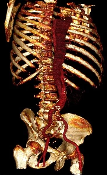Aortic dissection, 3D CT scan
