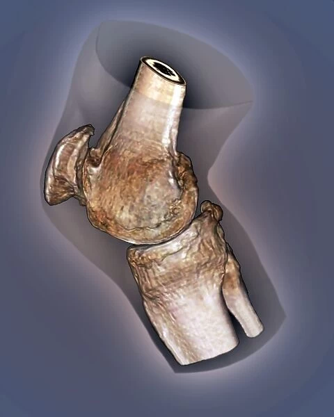 Arthritis of the knee, 3D CT scan C016  /  6511