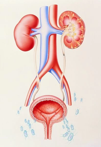 Artwork showing cystitis leading to pyelonephritis