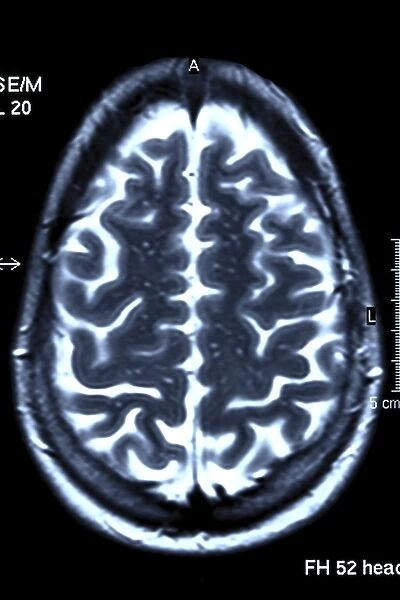 Brain scan, MRI scan F006  /  4617
