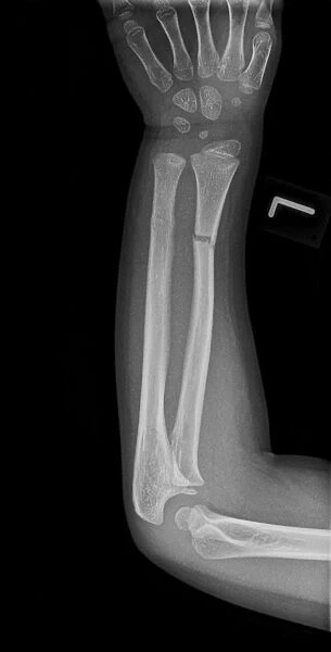 Broken arm, X-ray C017  /  7264