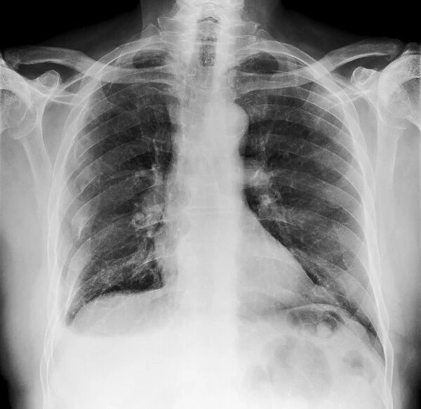 Broken ribs, X-ray C017  /  7566