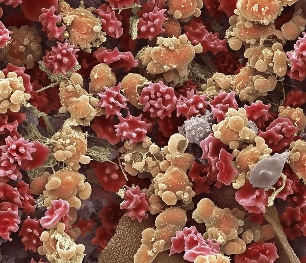 Cells from a urine infection, SEM