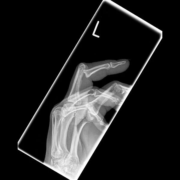 Dislocated finger, X-ray C017  /  7183