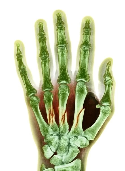 Fractured palm bones of hand, X-ray