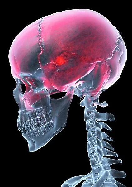 Headache, X-ray artwork