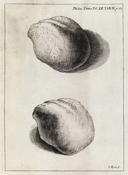 Kidney stone, 18th century