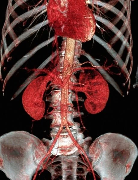 Normal abdomen, 3D CT scan