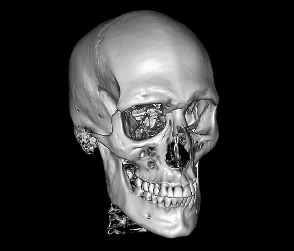 Normal skull, 3D CT scan C016  /  6328