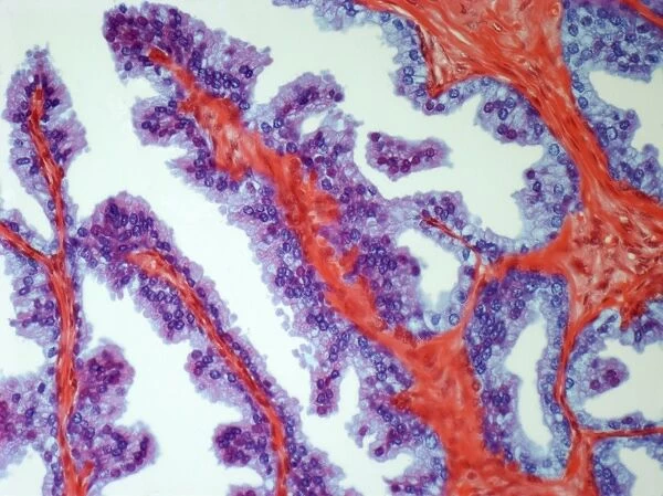 Prostate cancer, light micrograph F005  /  6093