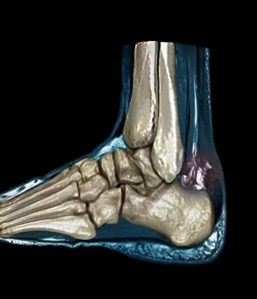 Ruptured Achilles tendon, MRI C018  /  0649