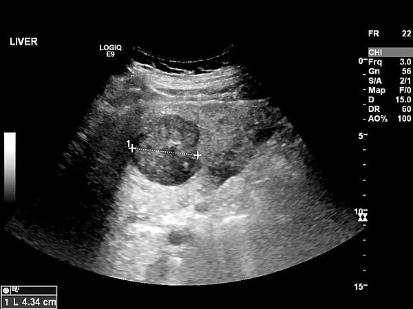 Secondary liver cancer, ultrasound scan C017  /  7764