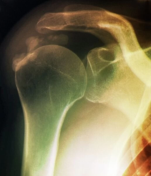 Tendinitis of the shoulder, X-ray