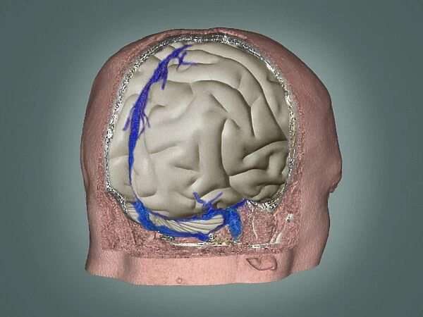 Thrombophlebitis in the brain, 3D CT scan