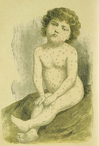 Child suffering from Measles (Rubeola : Morbilli), a widespread viral infection spread by air-borne droplets. A routine vaccine was not available until 1964. From Jules Rengade Les Grands Maux et les Grands Remedes, Paris, c1890