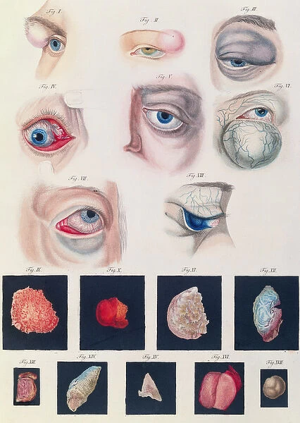 Description of congenital eye anomalies, from Klinische Darstellungen der