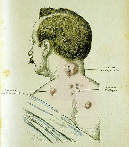 Development of pustules in a man suffering from Anthrax, 19th century (engraving)
