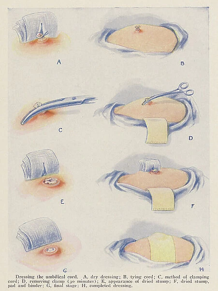 Dressing the umbilical cord after childbirth (colour litho)